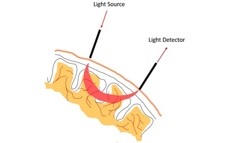 精神疾病臨床分類(lèi)診斷中功能性近紅外光譜技術(shù)的應(yīng)用