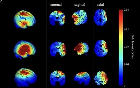 fNIRS研究顯示：多靶點(diǎn)比單靶點(diǎn)HD-tDCS刺激更能改善反應(yīng)抑制