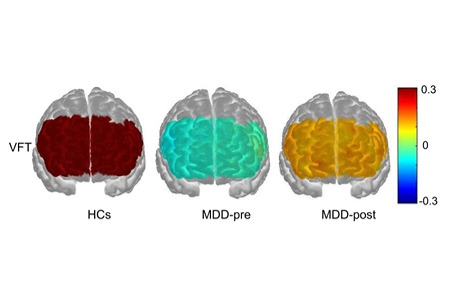 四川大學(xué)華西醫(yī)院運(yùn)用功能性近紅外成像探究rTMS治療抑郁癥機(jī)制