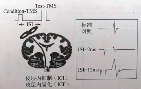科普丨前途無(wú)量的TMS新模式——單拍成對(duì)脈沖刺激（pTMS）